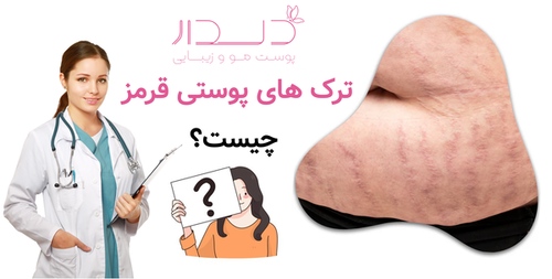 ترک های پوستی قرمز چیست؟