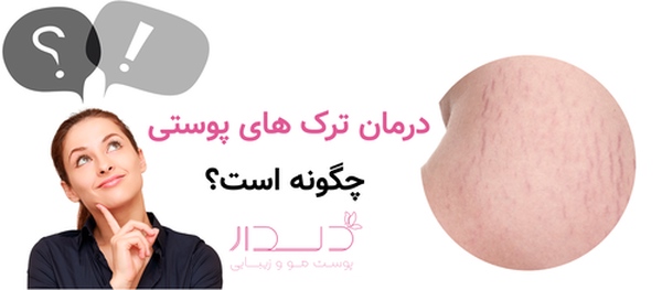 درمان ترک های پوستی چگونه است؟