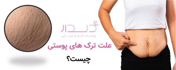 علت ترک های پوستی چیست؟