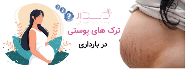 ترک های پوستی در بارداری