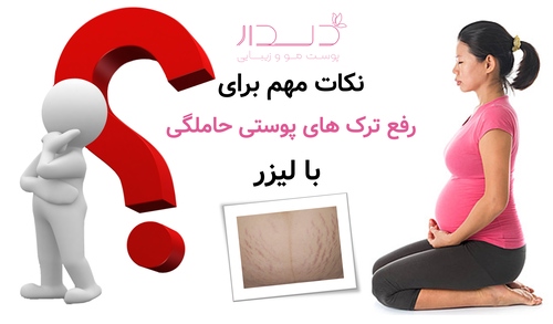 نکات مهم برای رفع ترک های پوستی حاملگی با لیزر