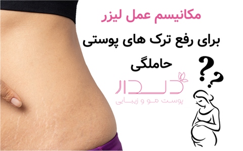 مکانیسم عمل لیزر برای رفع ترک های پوستی حاملگی