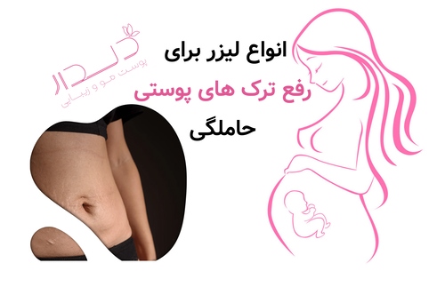 انواع لیزر برای رفع ترک های پوستی حاملگی